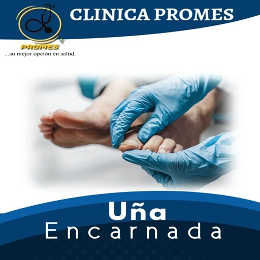 Extracción de Uña